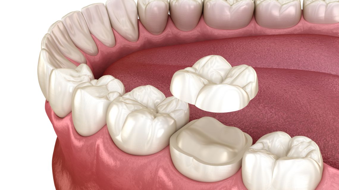 Crowns & Bridges Overview